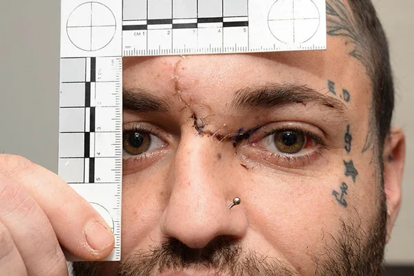 Victim's eye wound 