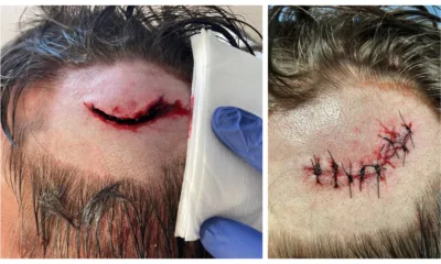 Images of the injuries inflicted by Louie McKillop on another man at The College Arms, Peterborough, last Christmas Eve