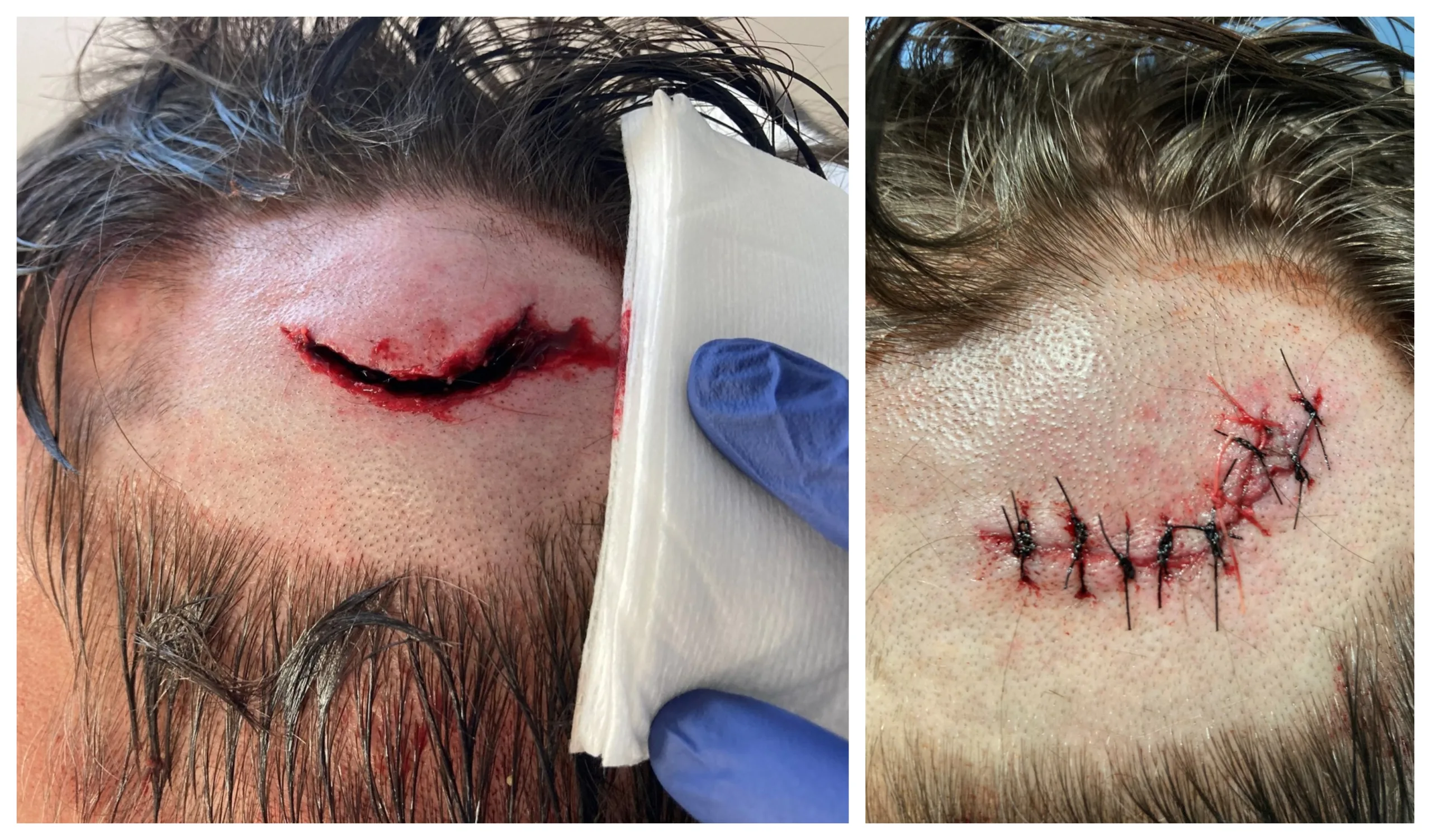 Images of the injuries inflicted by Louie McKillop on another man at The College Arms, Peterborough, last Christmas Eve Images of the injuries inflicted by Louie McKillop on another man at The College Arms, Peterborough, last Christmas Eve