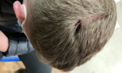 Photo of the injury sustained by a 16-year-old boy from Whittlesey after he was attacked by two women, one of whom has now been given a 12 months suspended prison sentence.