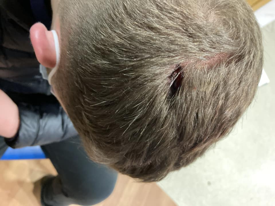 Photo of the injury sustained by a 16-year-old boy from Whittlesey after he was attacked by two women, one of whom has now been given a 12 months suspended prison sentence.